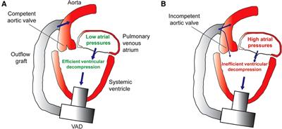 Considerations of valvular heart disease in children with ventricular assist devices